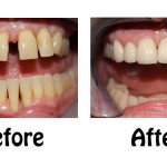 SS2BeforeAfter